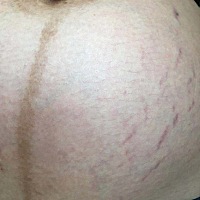 从33周开始长妊娠纹了，现在34周了，好不开心，还有最后一个月，不知道肚子要花成什么样。好丑😭😭...