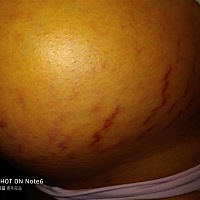 啊，长妊娠纹了，怎么办呀😱😱😱