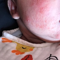 有经验的宝妈知道这是长的啥，是湿疹吗？可以擦什么药