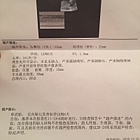 nt   胎心率161  是不是有点高   可能是个女孩