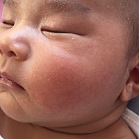 求助大神  宝宝47天  面部像是湿疹  怎么办？