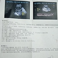今天去产检，医生说我宫颈长度短，要卧床休息，容易早产。有没有知道的朋友，帮我看看，心里害怕失去。