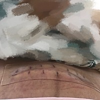 痛了三天、吃不了睡不了、结果顺不了、只能刨。看到这伤口就想哭、真的很不容易、