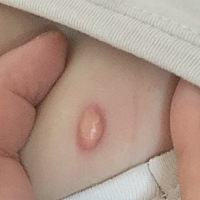 我儿子身上起了一颗这疙瘩。有遇到类似情况的宝宝妈么？求指教
