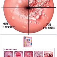 从宫颈糜烂到宫颈癌，仅一步之遥！【体质好、不治疗】3-7年癌变【体质差、不治疗】1-2年癌变亲爱的，️...