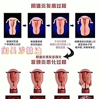 💥为什么宫颈癌都是中晚期才发现❓󾠮 宫颈没有痛觉神经。󾠯 自己没办法看到。宫颈糜烂的女性白带...