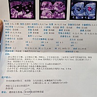 昨天唐筛结果出来说是有高风险，叫我今天去医院检查，今天已经去医院照了四维了，医生说没有发现问题，...