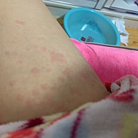 身上过敏，奇痒无比，有没有出现这样的问题的，也没敢给喂奶水