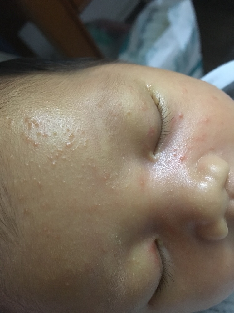 宝妈们帮忙看看脸上长的什么东西，要怎么处理？