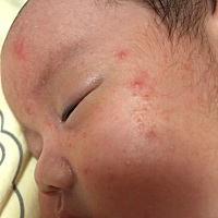 宝宝起湿疹啦！哪位大神知道怎么好的快呀！只有脸上有！起白头啦！心急呀！求告知！