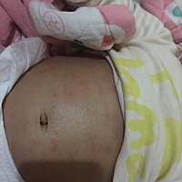 哪位宝妈知道宝宝这种情况该擦什么药。以检查牛奶过敏，没接触牛奶，身上疹子也经常有。