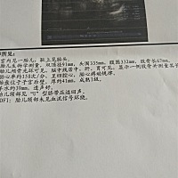 怎样从B超算出宝宝在肚子里多少斤，顺便看下是男是女