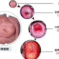 什么是宫颈糜烂？ 宫颈糜烂很大程度上会对受孕以及妊娠产生影响，根据严重程度，女性需要在受孕前进行相...