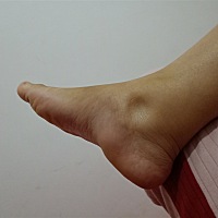 11月27号预产期，脚肿成这样，有什么可以缓解？