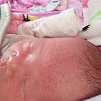 额头一大片紫色红点在皮肤里面，是夹的嘛？这么久还不消。有类似的宝宝吗求分享