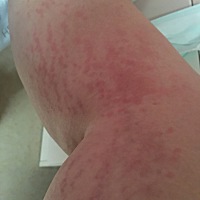 产后妊娠纹巨痒怎么办啊？😭真的受不了啦！快疯了！已经被我抓成这个样子了，越抓越痒！越抓越多！实...