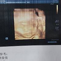 四维和心脏彩超顺利过关  感恩一切🙏 今天下午去检查的一切顺利过关  本身都胖 肚皮太厚  影像看的不...