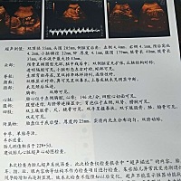 谁会看彩超图，求看男女宝宝哟！今天做四维彩超啦，宝宝不配合，可害惨妈妈了，真淘气有同款宝宝吗？