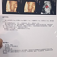 感恩节的礼物宝宝今天很配合一次过，后期继续健健康康