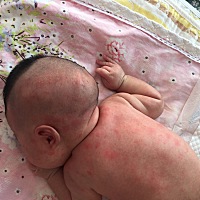 孩子起一脸一头的疙瘩，咋办啊！急死了