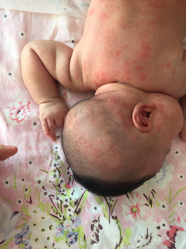 孩子起一脸一头的疙瘩，咋办啊！急死了