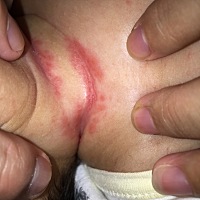 各位宝妈，这是淹脖子还是湿疹啊？怎么处理啊。