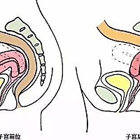 子宫后倾本身不是造成不孕的元凶，反而是形成后天性子宫后倾的原因，才是造成不孕的因素，例如骨盆腔沾...
