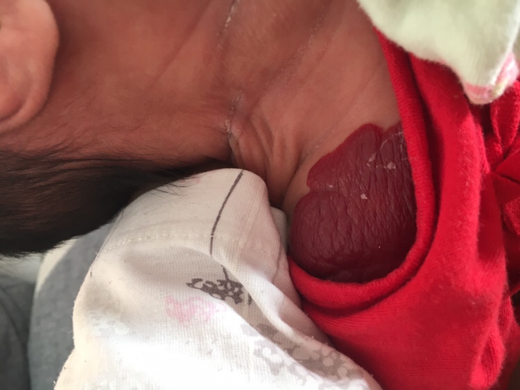 有宝妈知道这是属于胎记吗 对孩子对孩子有影响吗