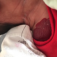 有宝妈知道这是属于胎记吗 对孩子对孩子有影响吗