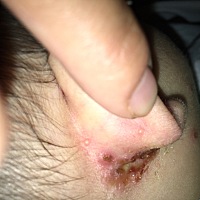 宝宝耳根一直有点湿疹反反复复前两天突然加重医生说用碘伏抹了更严重了换家医院用百多邦也不行又换了家...