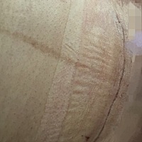 今天是刨腹产12天大家看看刀口恢复得咋样