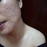 脸上从青春期一直长痘，现在终于好了