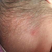 宝宝头上长的这是什么啊，在线等急，查了半天也没查到，需要什么办法可以消了，有经验的宝妈给点建议吧。