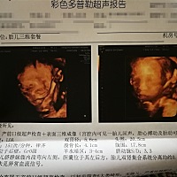 今天做了三维，结果看到胎儿脐静脉腹内段向左弯，后来给产科门诊医生看结果她让我再约一个胎儿心超再看...