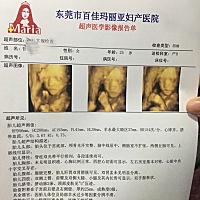 昨天去拍四维，没想到宝宝不配合，不肯翻身，医生让我去爬楼梯，拍了3次，爬了3次楼梯都不肯动，吃...