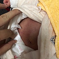 宝宝肚子上这两天出现一块紫块，这是什么情况呀？好担心，还有这两天宝宝不愿吃奶，吃一吃就大哭，然后...