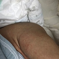 小朋友身上红色一点点的 有没有宝妈帮忙看下是什么