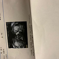 医生说我孩子没用了，我要求的保胎。三天后检查人绒毛膜促性腺激素也没升还是老样子。还有这三种药可以...