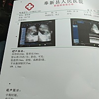 胎心率是不是太高了？会缺氧吗？？？