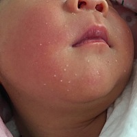 各位麻麻们～宝宝脸上的白点点是湿疹吗？需要用什么药吗？