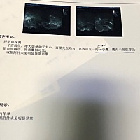 上月2号来的月经，12月6日查孕酮23.21，hcg1094.49，偶尔会腹痛于是今天查了阴超，可是见孕囊，未见胚芽...