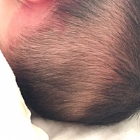 有没有一样的宝宝 头发一圈很少 而且头皮还有点红 有一样情况去看过医生的吗