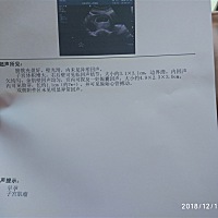 今天去做了第一次检查，胎心胎芽正常，但是有子宫肌瘤😓医生说对宝宝没有影响。。。 有没有情况差不多...