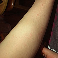 怀孕一个多月 脚趾头很痒 小腿上红红的一片像被虫子咬过一样 有很痒 有没有宝妈也是这样的 这是什么情况...