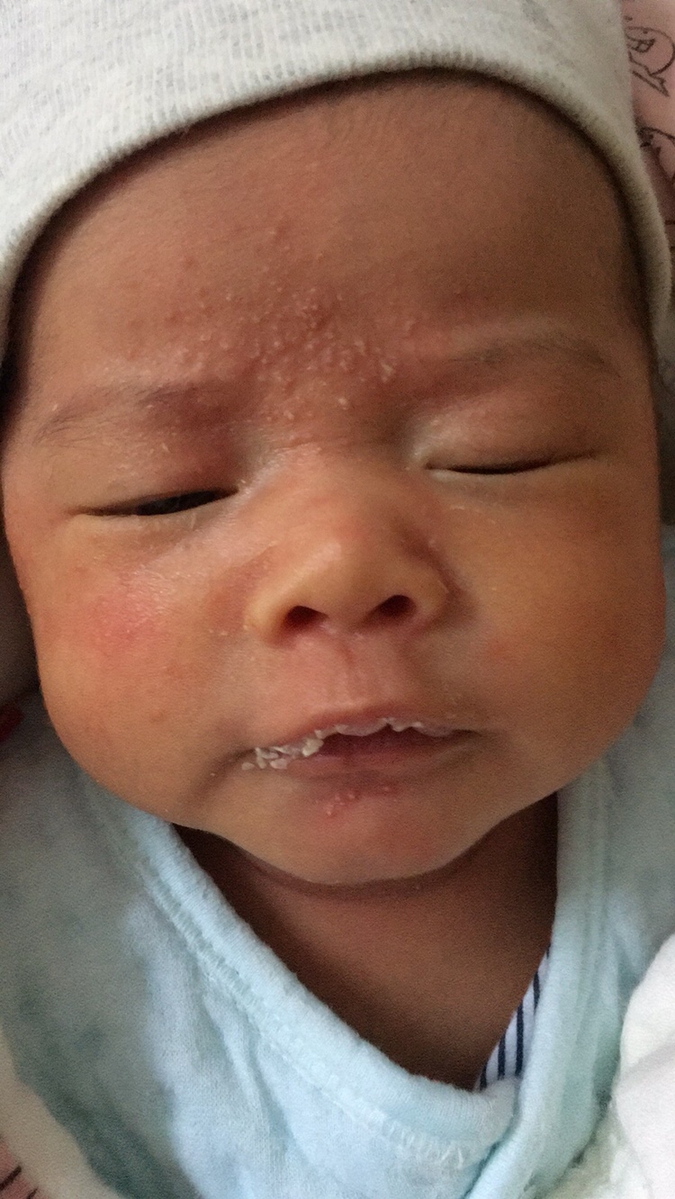 有知道宝贝额头，脸上长的是什么痘痘吗？都长脓了一样