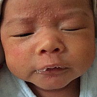 有知道宝贝额头，脸上长的是什么痘痘吗？都长脓了一样