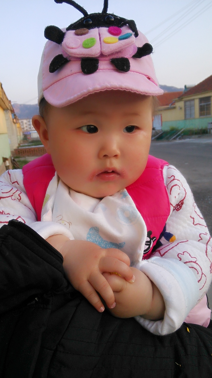 湿疹严重的时候嘴角两边都是红红的