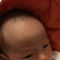 还没满月的宝宝，之前都是光光的脸上，这两天额头上长了一粒粒小红疙瘩，下巴也有一粒有白点，是湿疹吗...