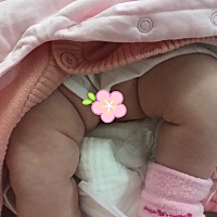 我宝宝两个月了，之前发现腿部褶皱不一致没在意，刚刚在网上查了下被吓一跳，有跟我宝宝腿部褶皱一样不...