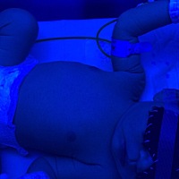 宝宝双十二出生的，出生第三天出现了急性黄疸，现在还在照兰光。生之前以为自己不会喜欢宝宝，生完后感...